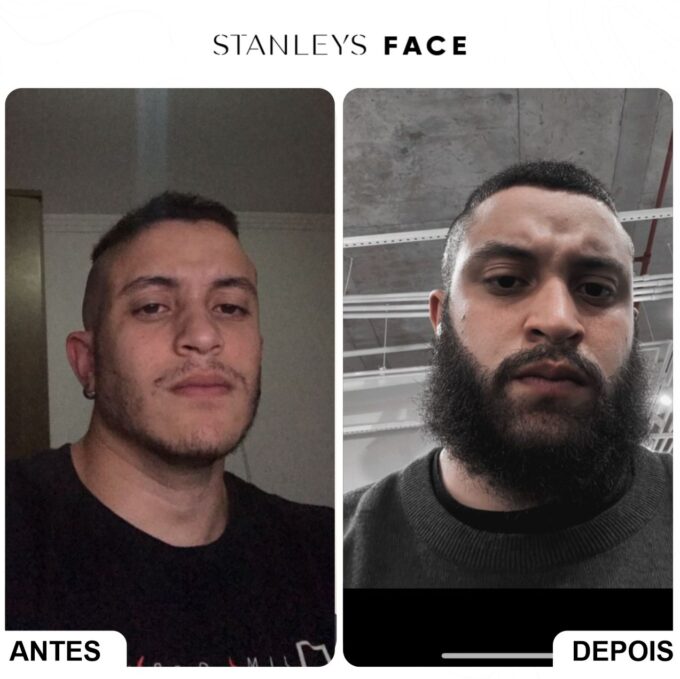 Antes E Depois